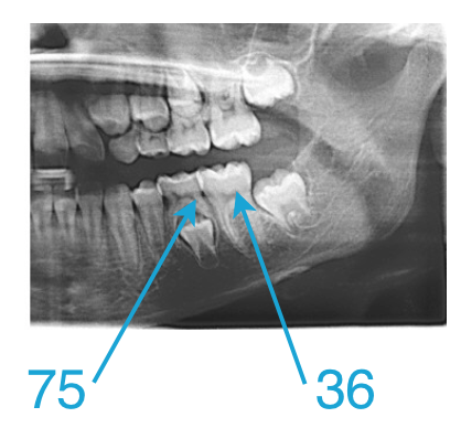 dentistion mixte